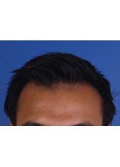 After Hair Transplant&nbsp;2 Sessions (Areas)